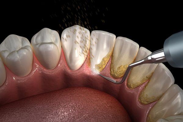 Dentist, Child Dentist, Teeth Cleaning at Masikhani Dental Practice in Polokwane